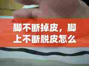 脚不断掉皮,脚上不断脱皮怎么办