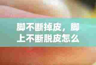 脚不断掉皮,脚上不断脱皮怎么办