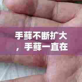 手藓不断扩大，手藓一直在扩散 