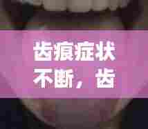 齿痕症状不断，齿痕严重吗 