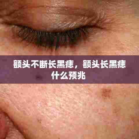 额头不断长黑痣，额头长黑痣什么预兆 
