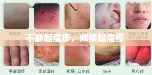 不断起湿疹,频繁起湿疹