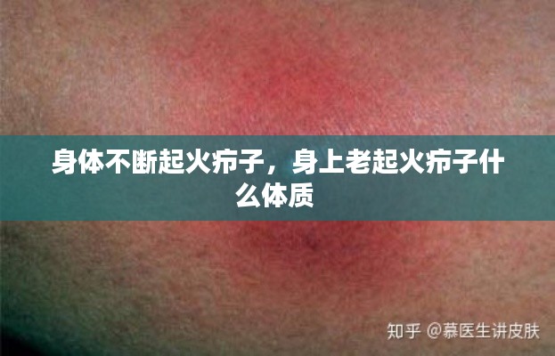 身体不断起火疖子，身上老起火疖子什么体质 