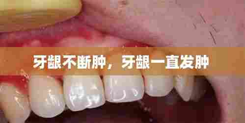 牙龈不断肿，牙龈一直发肿 