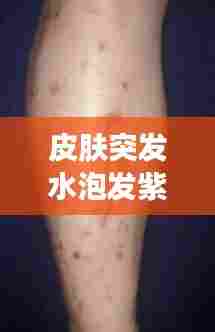 皮肤突发水泡发紫，皮肤紫色水泡 