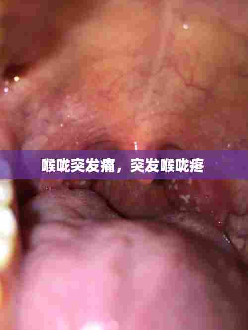 喉咙突发痛，突发喉咙疼 