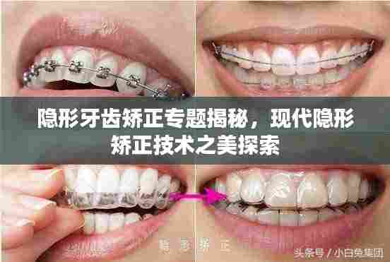 隐形牙齿矫正专题揭秘,现代隐形矫正技术之美探索