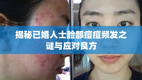 揭秘已婚人士脸部痘痘频发之谜与应对良方